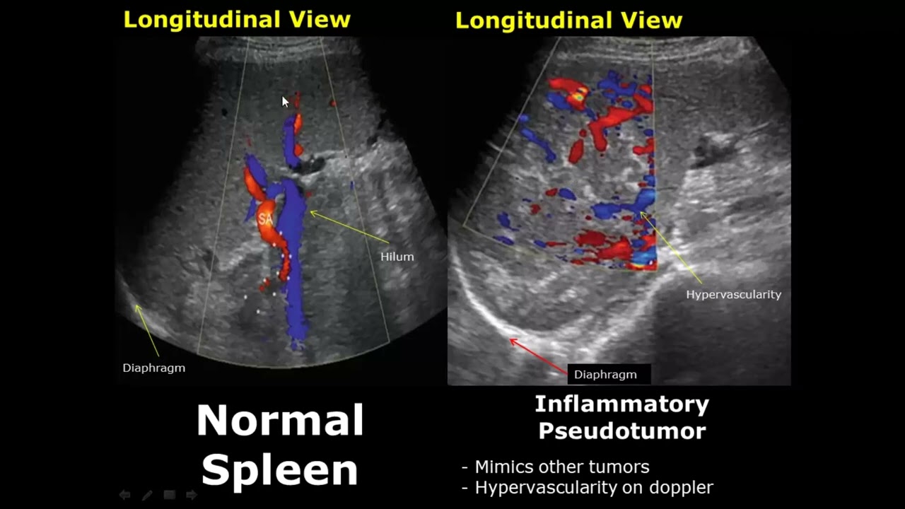 Spleen Ultrasound Normal Vs Abnormal Image Appearances Comparison ...