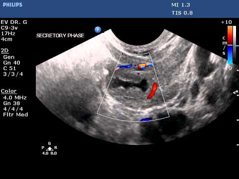 Corpus Luteum Ultrasound