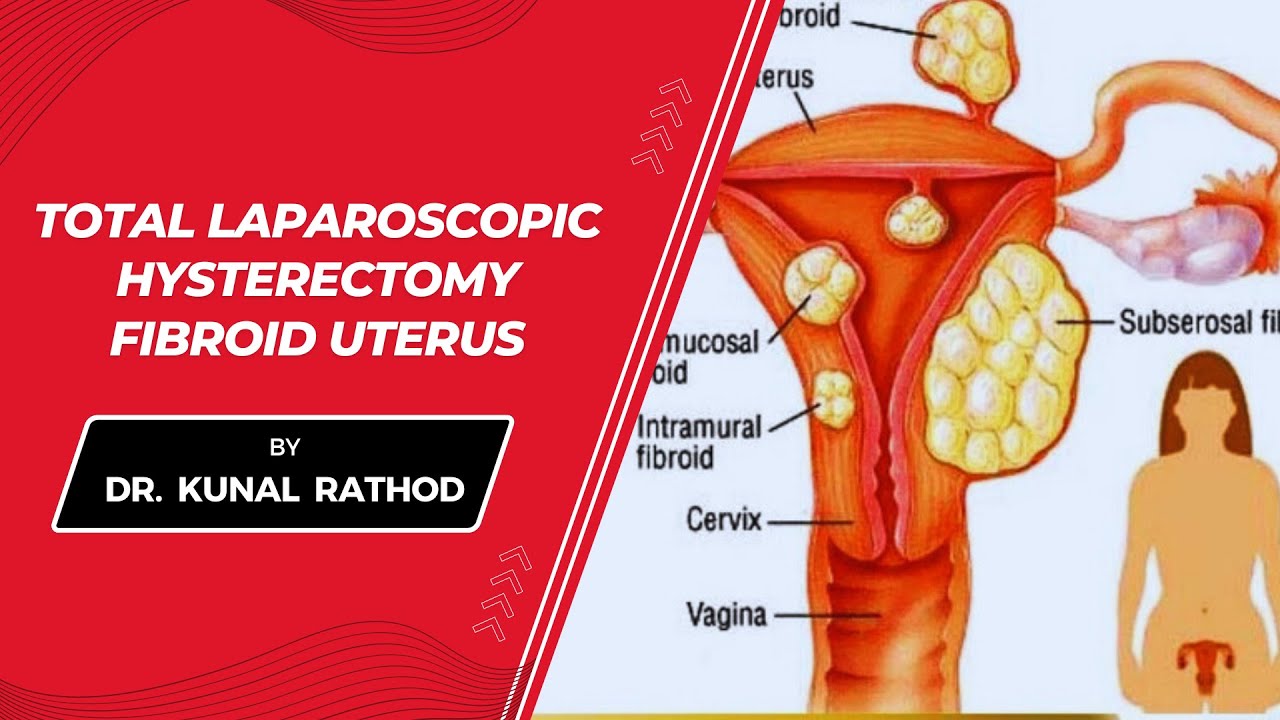 Total Laparoscopic Hysterectomy Fibroid Uterus | Dr Kunal Rathod - YouTube