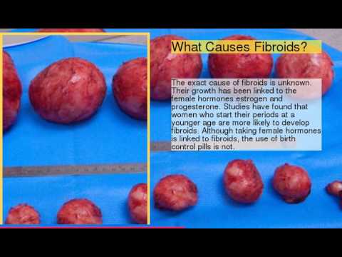 Fibroid Tumor Size Chart