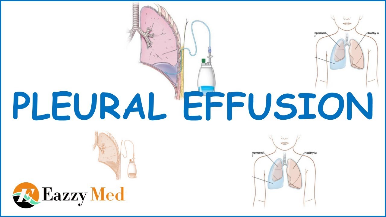 Pleural Effusion Causes ,Classification,Symptoms and Treatment - YouTube