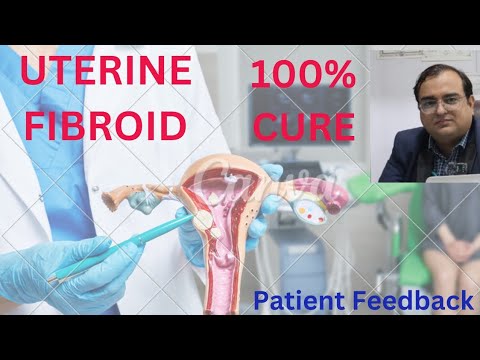 Fibroid uterus treatment without surgery|Homeopathic medicines for ...