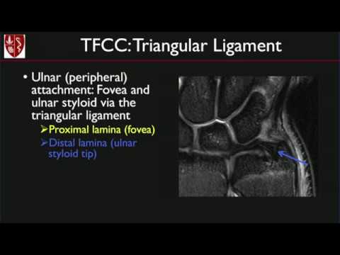 Ulnar Collateral Ligament Wrist Mri