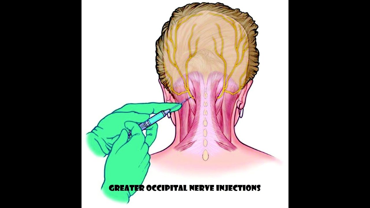 How To Treat Occipital Neuralgia 21 Of The Best Metho - vrogue.co