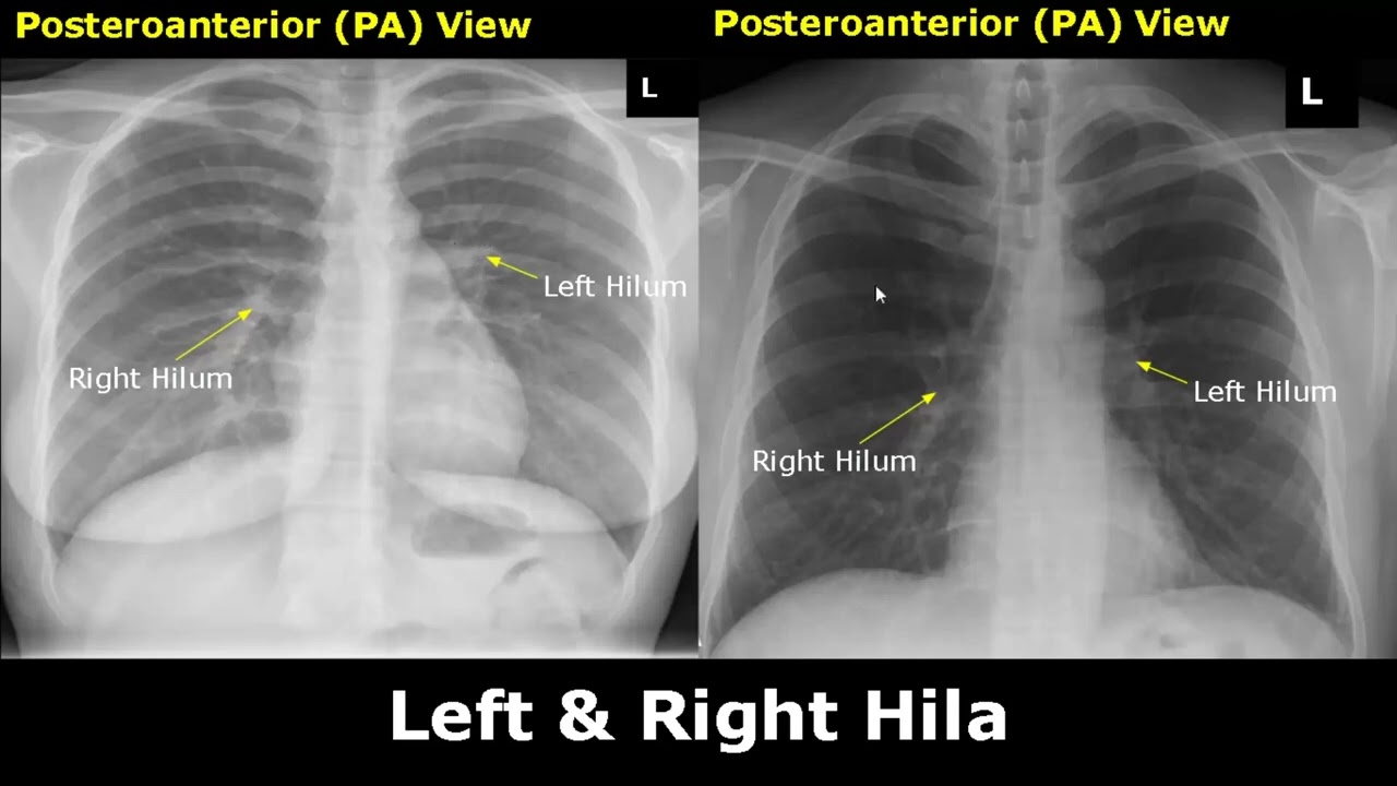 Normal Chest X Ray Labeled