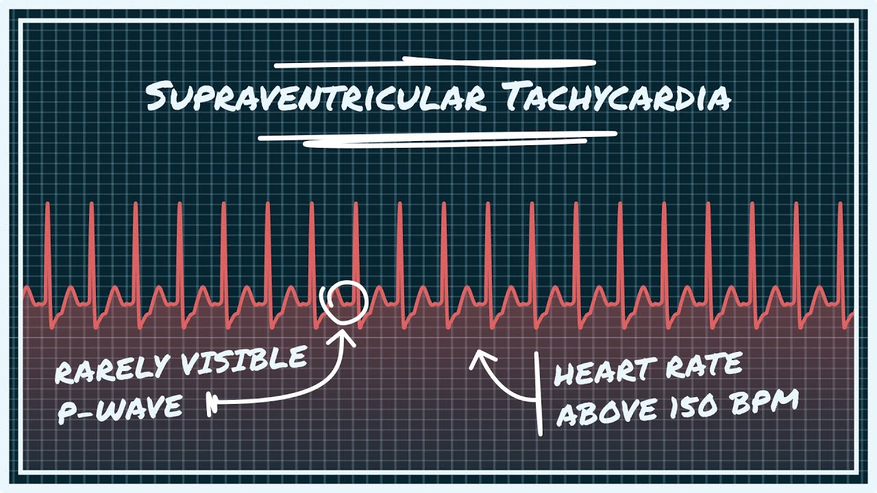 SVT - SUPRAVENTRICULAR TACHYCARDIA - Arrhythmias - Causes, symptoms ...