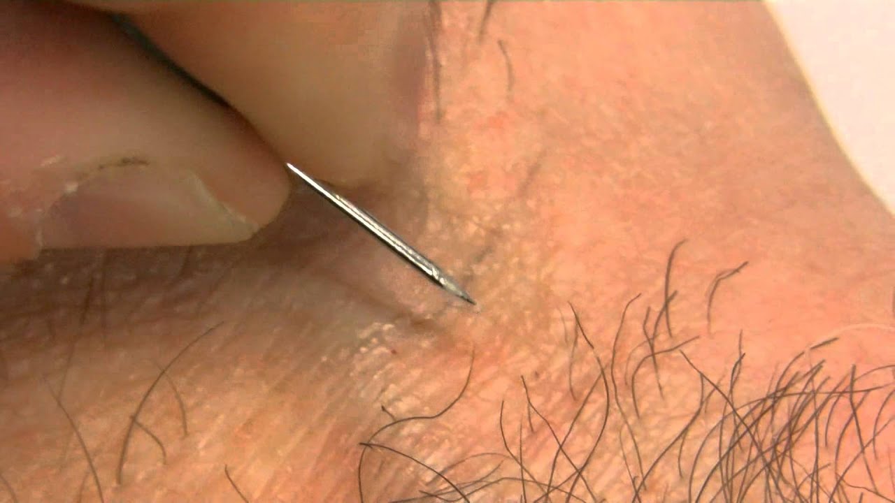 How To Remove An Ingrown Hair YouTube