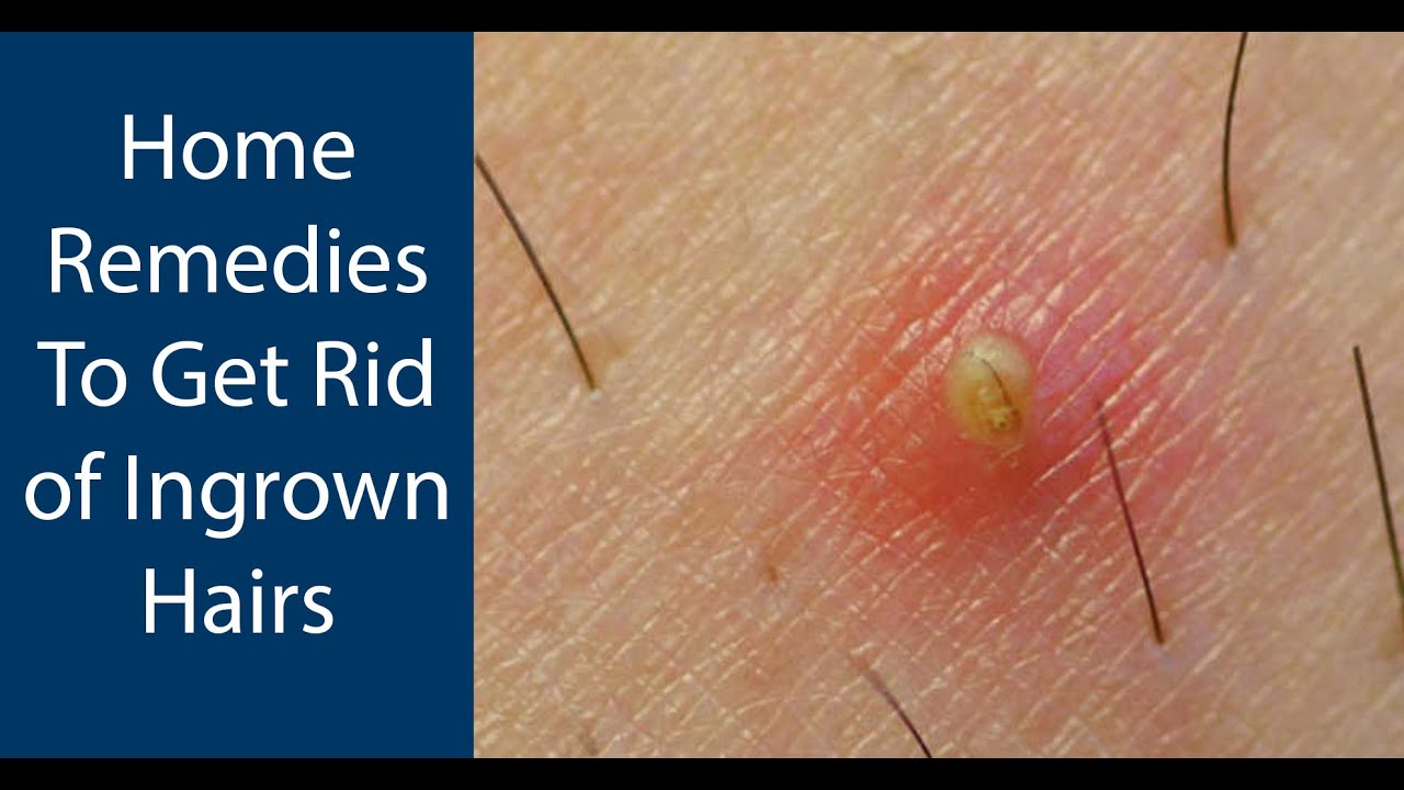 How To Get Rid Of Ingrown Hairs Natural Home Remedies YouTube