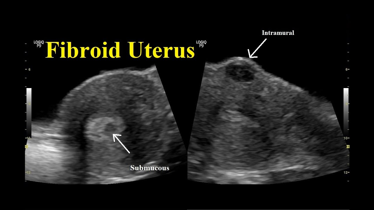 Intramural Fibroid Ultrasound