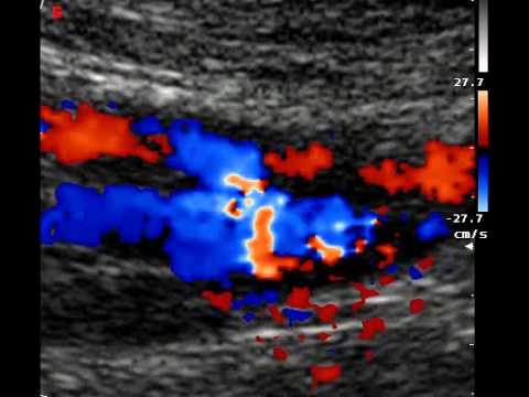 COMMON FEMORAL ARTERY- COMMON FEMORAL VEIN FISTULA - YouTube