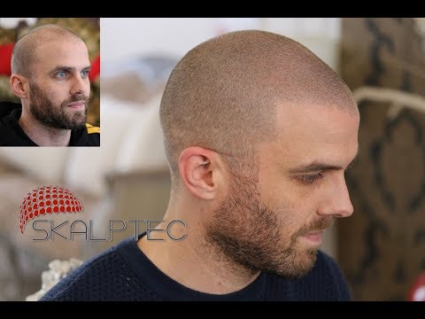 Hair Tattoo  Best Hair Tattoo Solution for Hair Loss  Skalptec Ltd