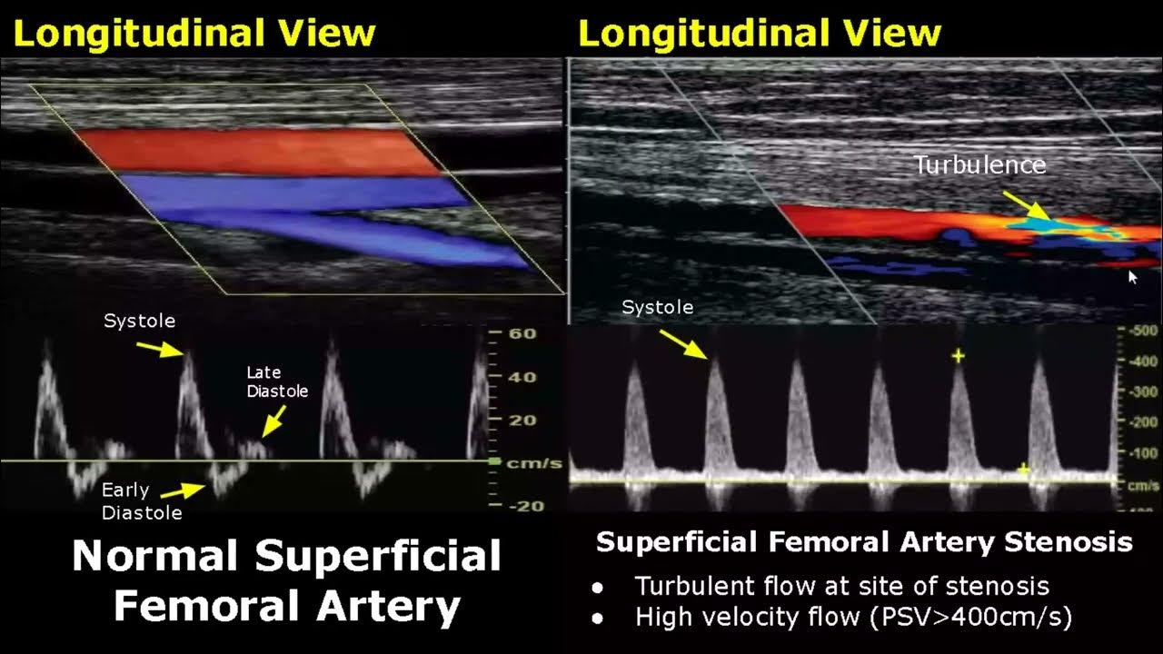 Femoral Artery Doppler Ultrasound Normal Vs Abnormal | Stenosis ...