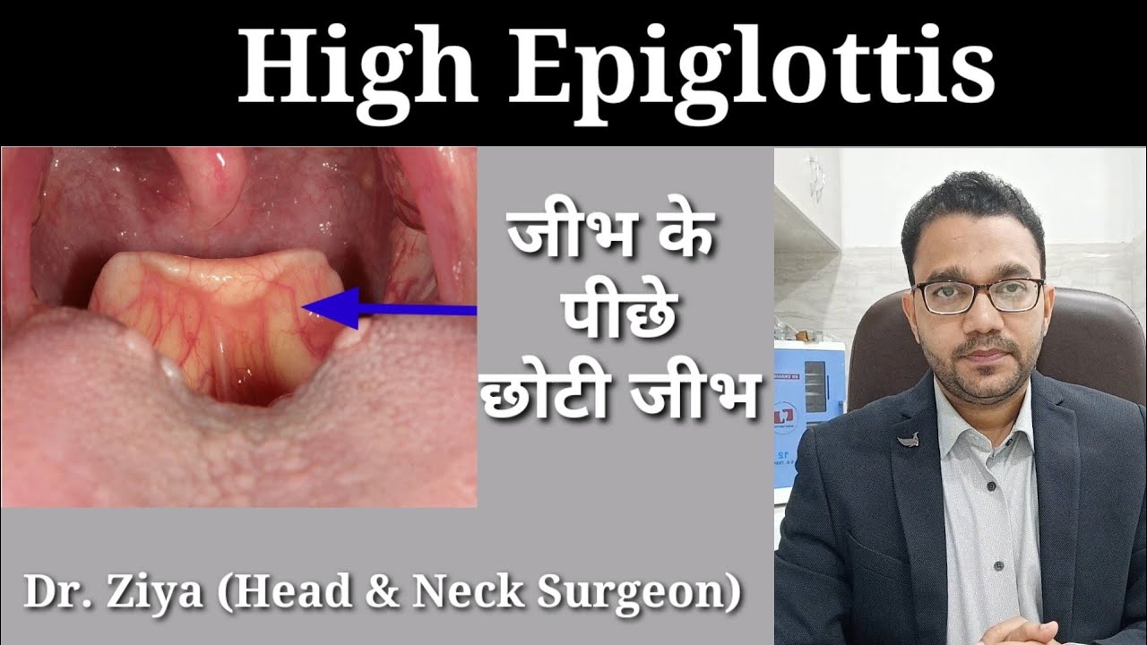 Leaf like structure in throat. High epiglottis. Epiglottis visible in ...