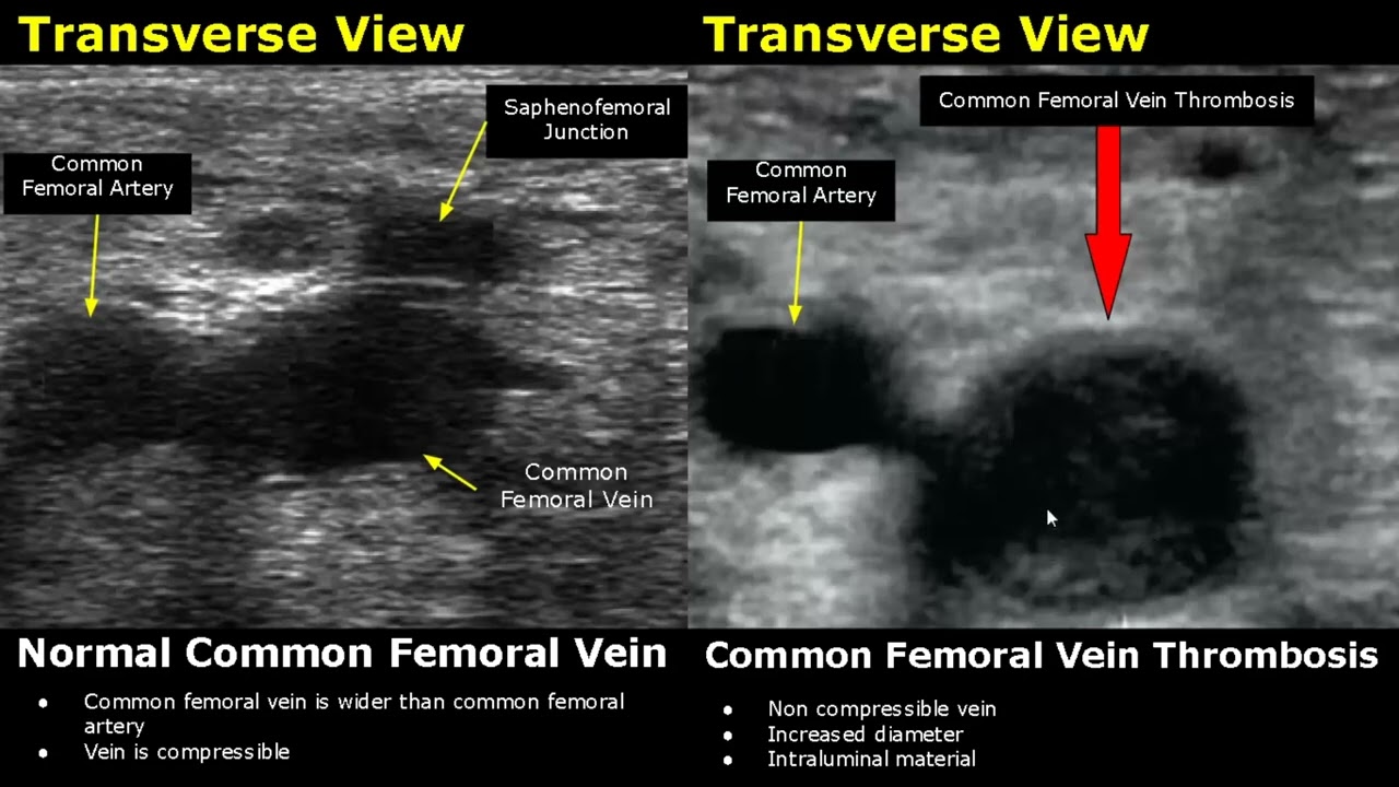 Femoral Artery Ultrasound