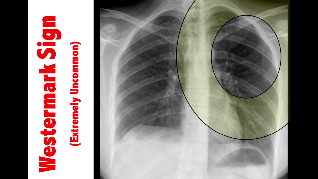 Chest X Ray Pulmonary Embolism