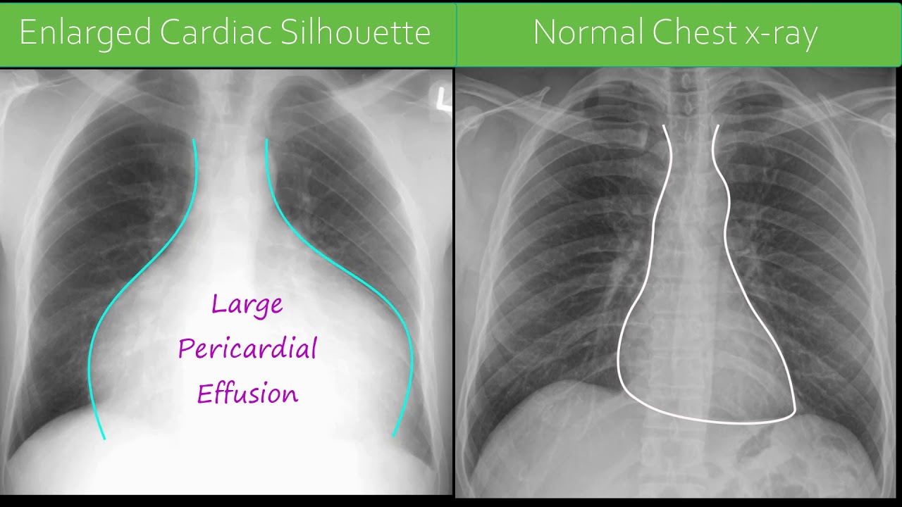 Pericardial Effusion X Ray