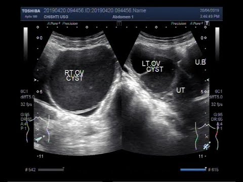 Simple Ovarian Cyst Ultrasound