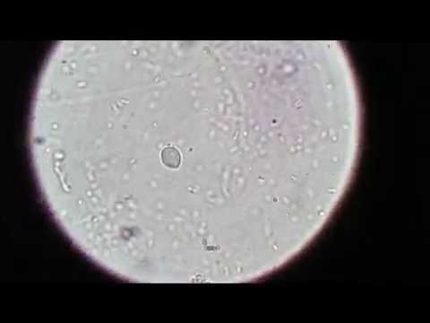 Trichomonas: The STD parasite no one seems to know about. - YouTube