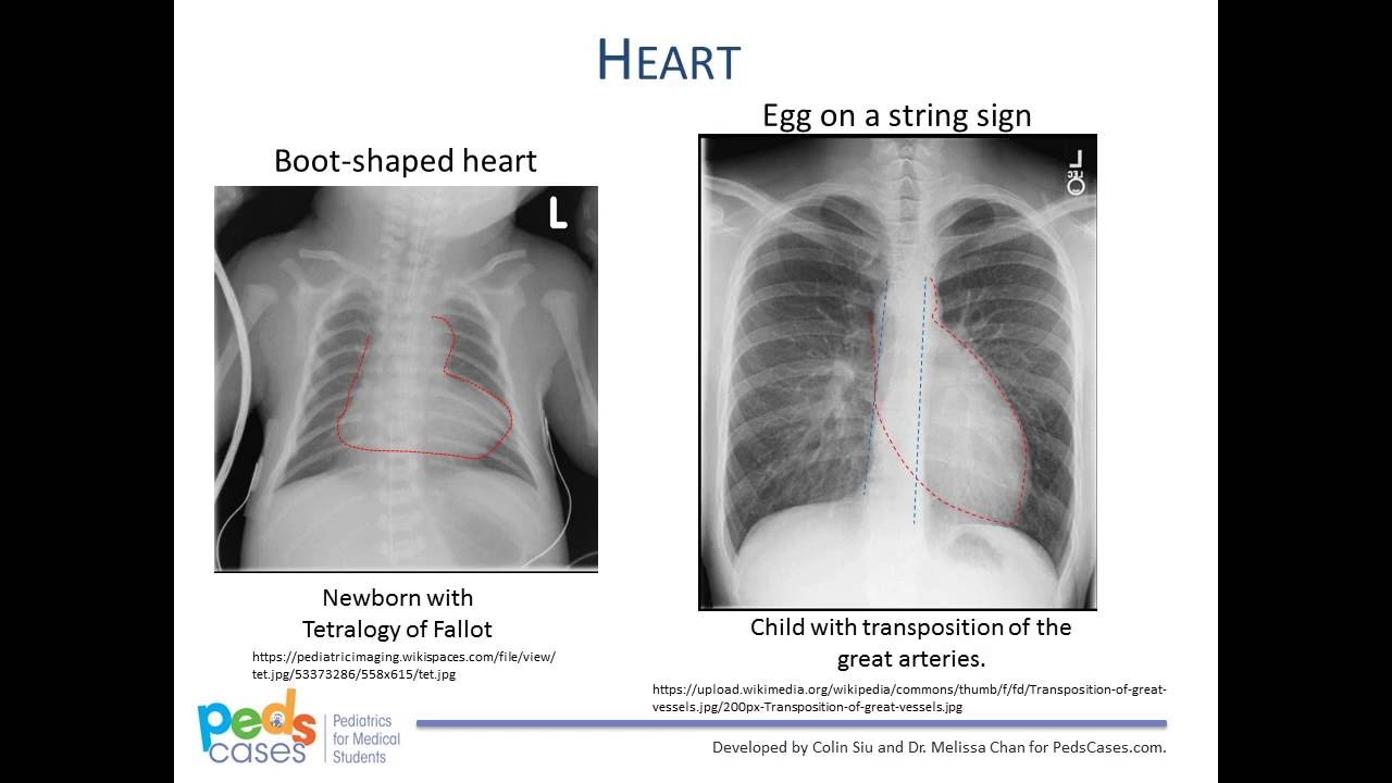 Normal Child Chest X Ray