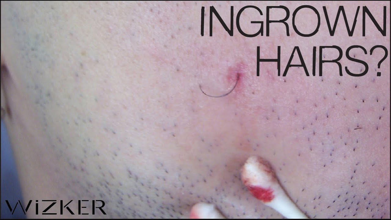 10 Causes Of Ingrown Hairs Revealed YouTube