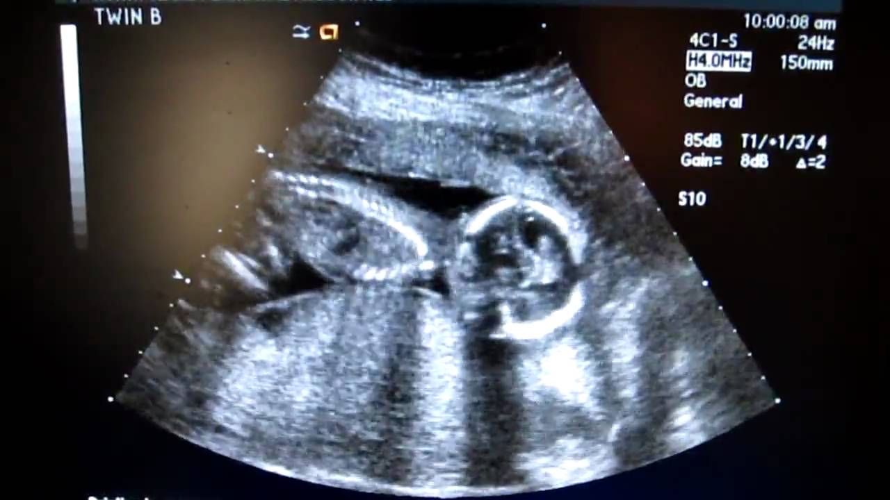 16 Week Twin Ultrasound