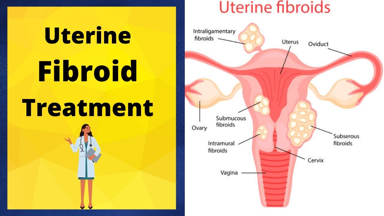 Uterine Fibroid, Uterine Fibroid Treatment - YouTube