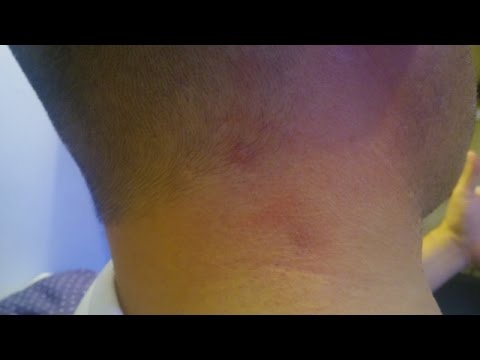 Cancerous Lumps On Back