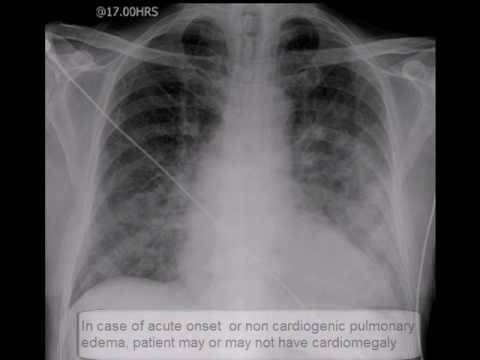 Chest x-ray, Pulmonary edema, lungs - YouTube