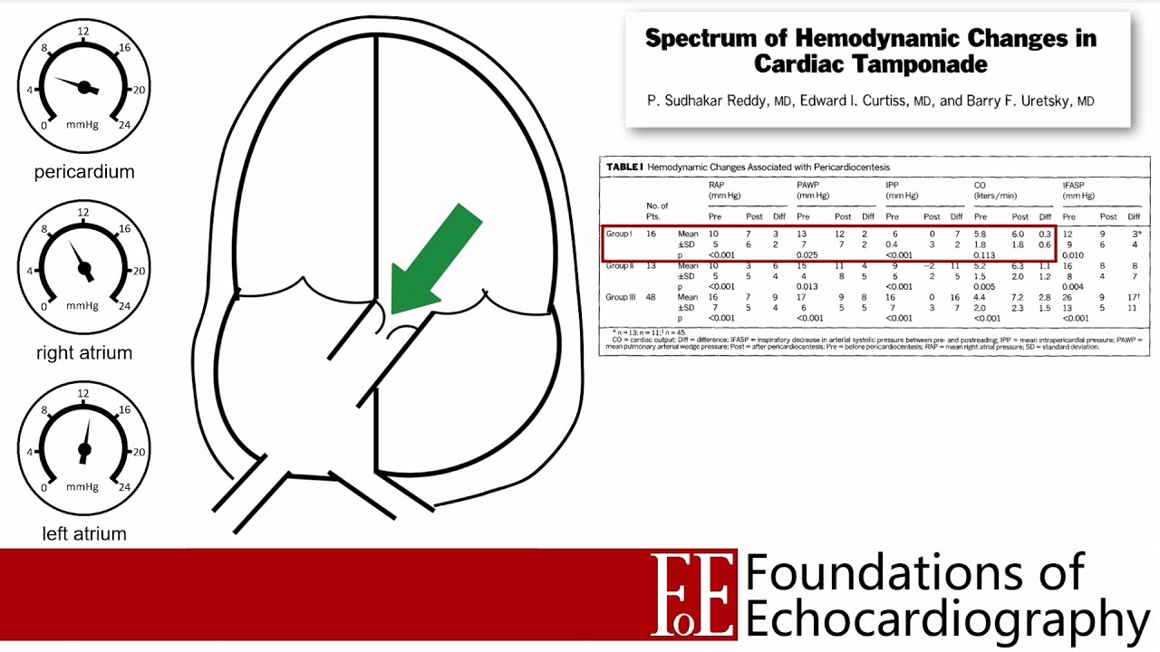 Level 1 Video Lecture: Pericardial Effusions and Cardiac Tamponade ...