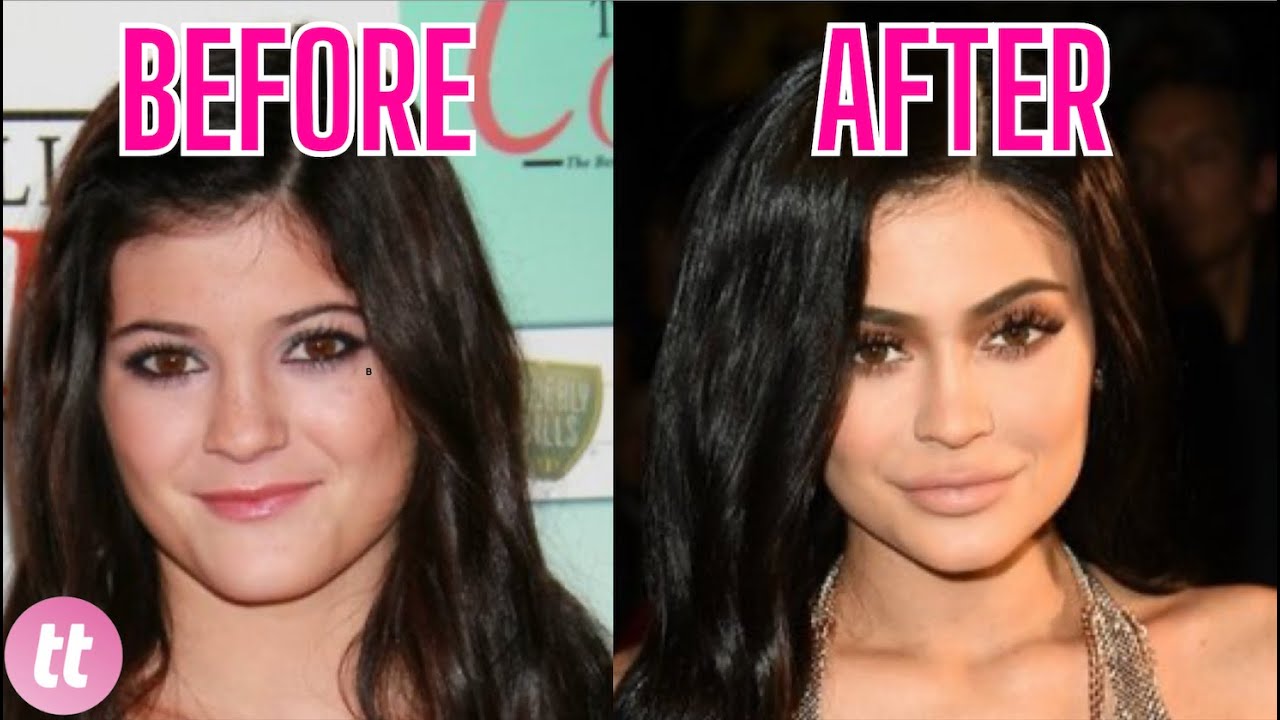 Kylie Jenner's Fixation on Plastic Surgery: Unveiling the Reality Behind Her Transformations