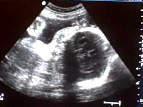 Baby Girl Acevedo Sonogram 32 weeks - YouTube