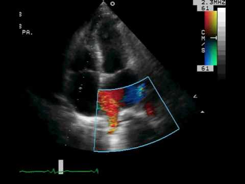 Transthoracic ECHO Pulmonary Veins - YouTube