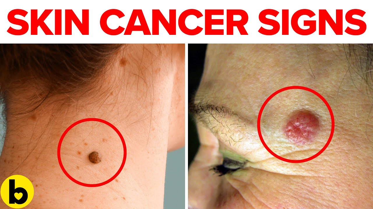 5 Warning Signs Of Skin Cancer