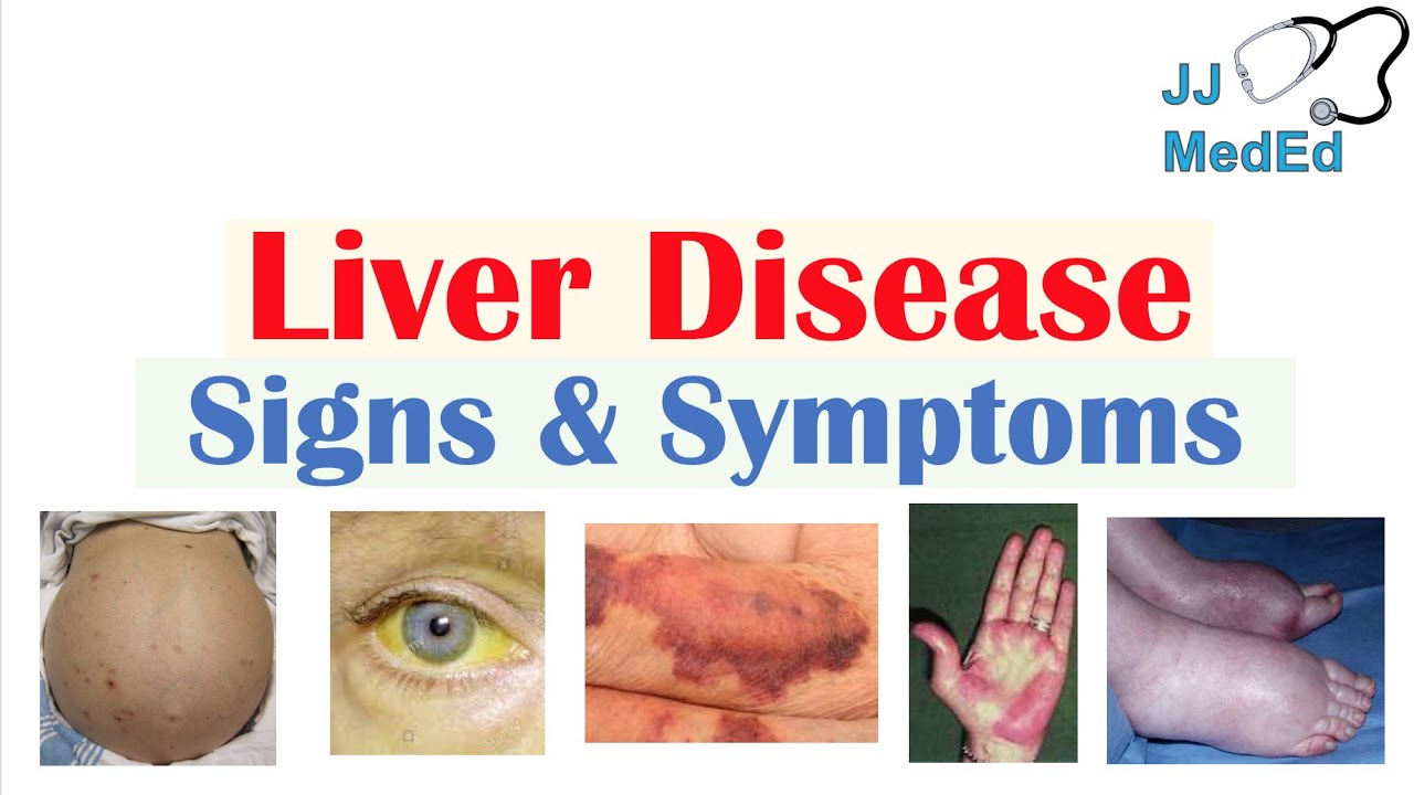 Pictures Of Cirrhosis Of The Liver Symptoms - the meta pictures