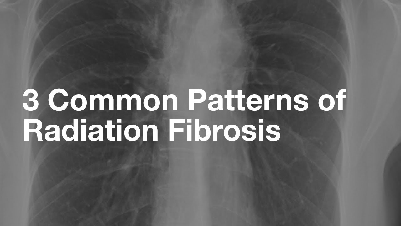 3 Common Patterns of Radiation Fibrosis (not from lung cancer) - YouTube