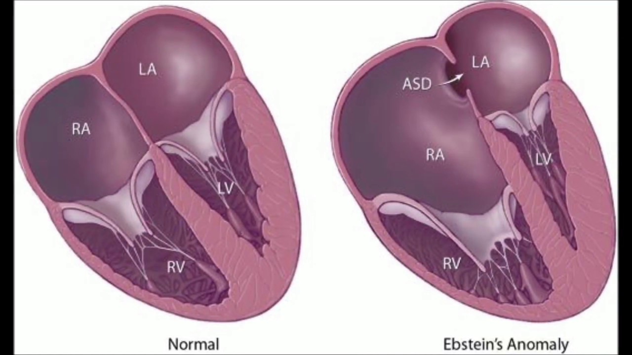 Ebstein's Anomaly - YouTube