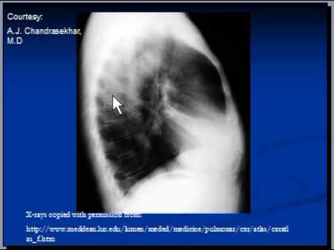 Chest x-ray interpretation --Right middle lobe collapse - YouTube