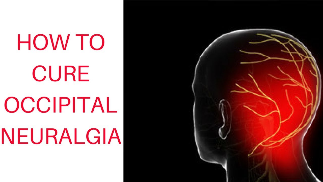 Neuralgia Symptoms