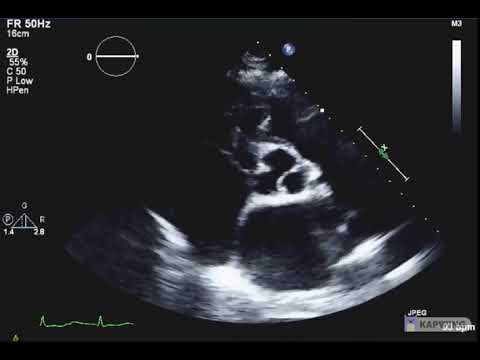 Infective Endocarditis AORTIC valve-Mercedes view - YouTube