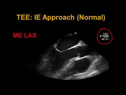 Infective Endocarditis Echo