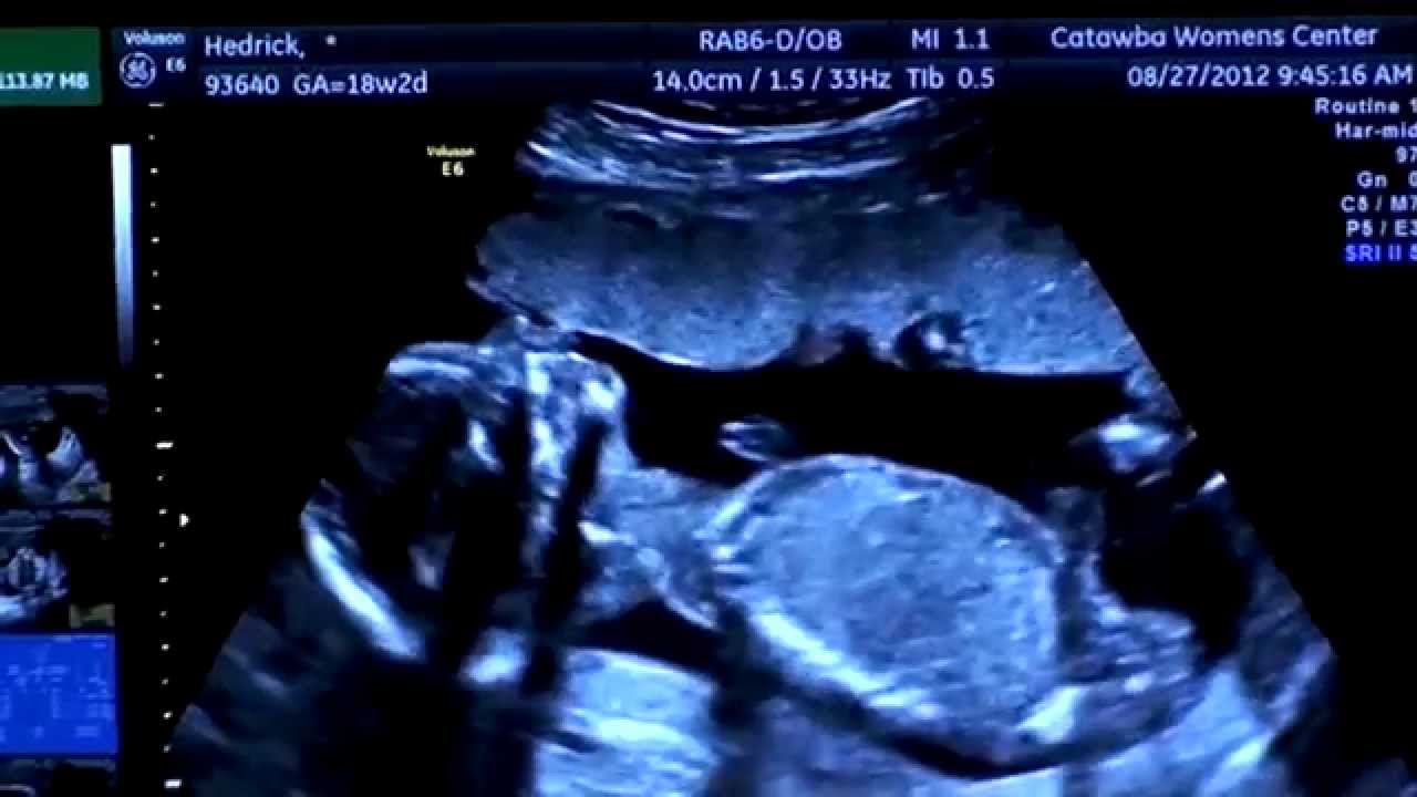 18 Week Ultrasound. What is the gender?!?! - YouTube image.