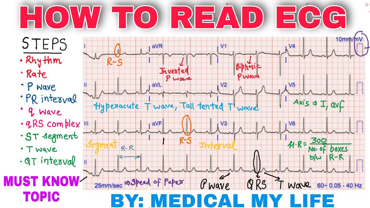 How Do You Read An Ecg For Beginners - Printable Templates Protal