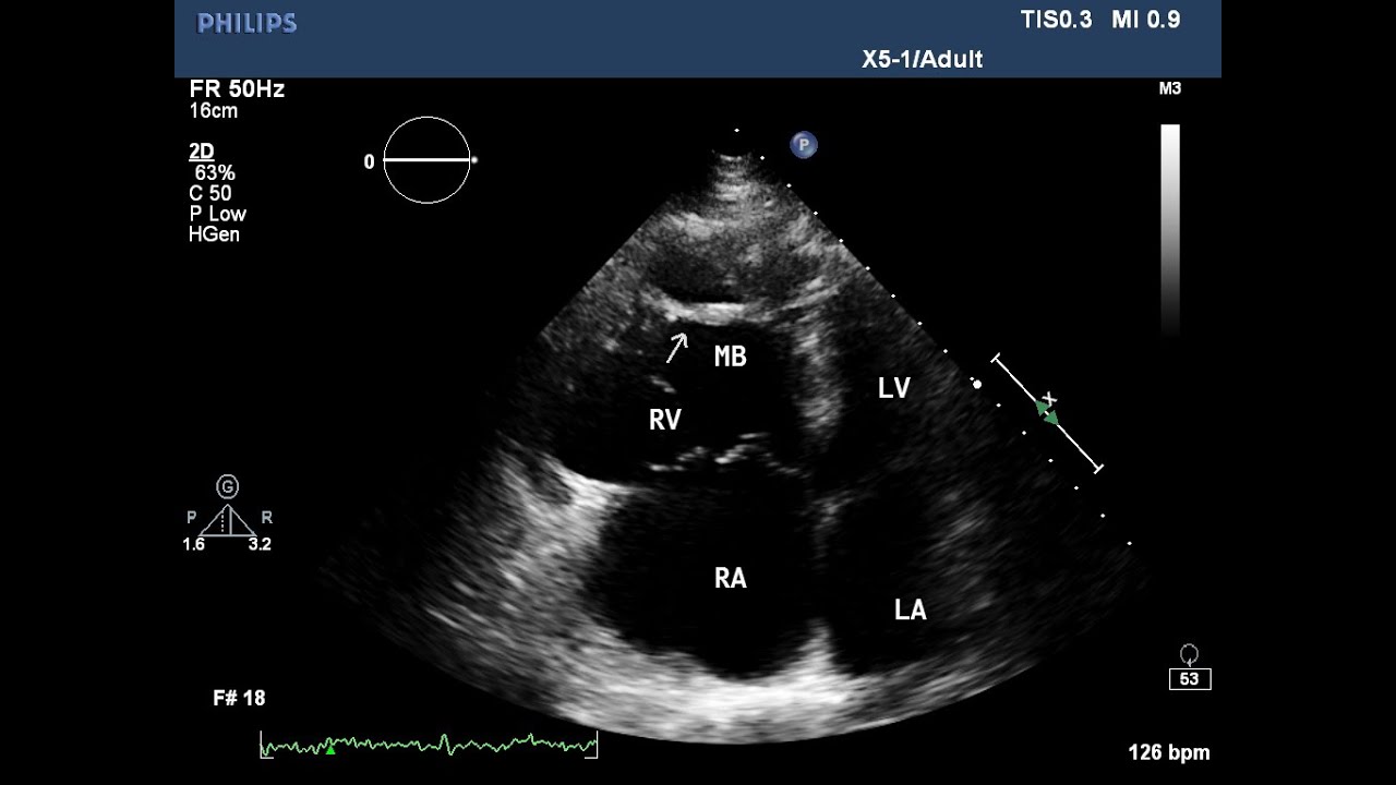 Arrhythmogenic Right Ventricular Dysplasia Echo