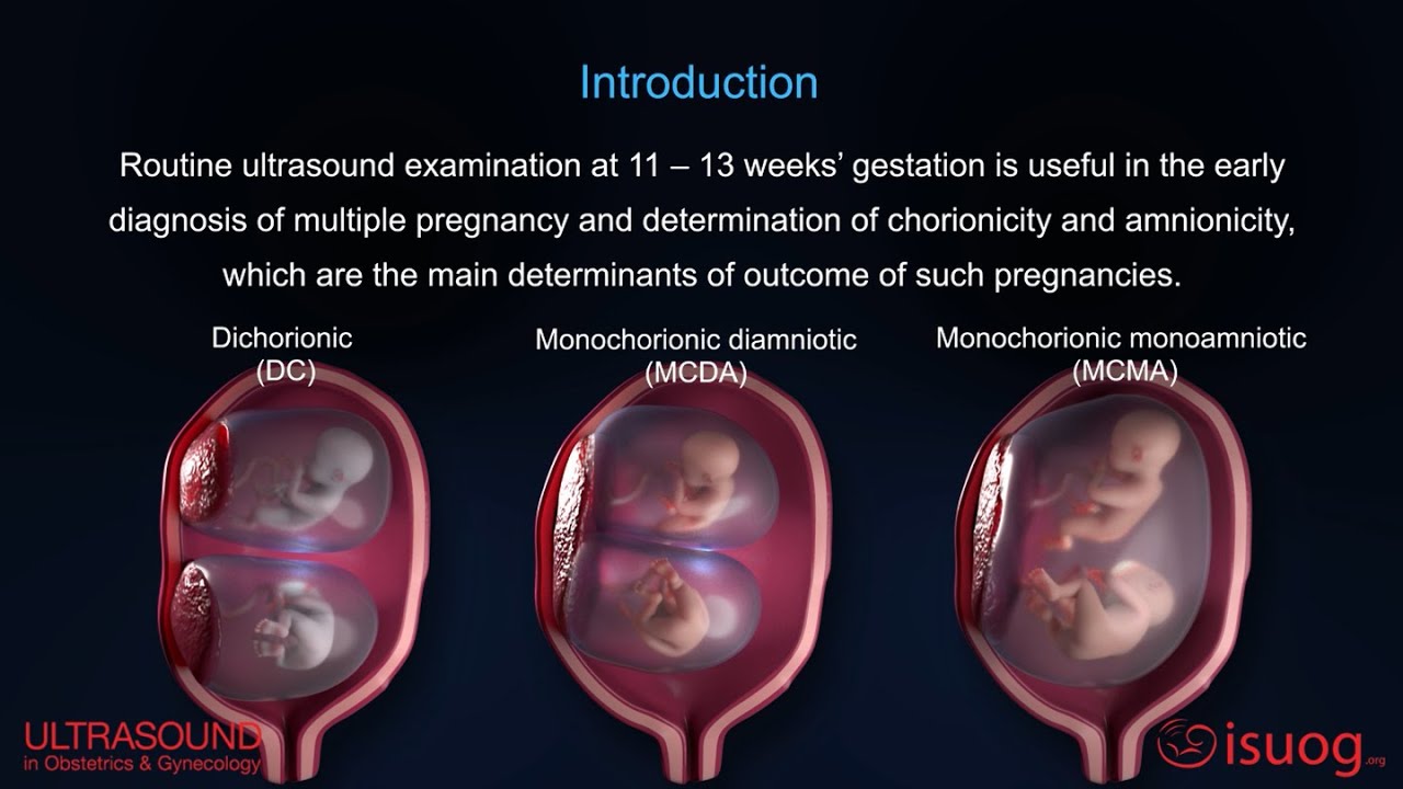 UOG video abstract: Outcome of twin pregnancy with two live fetuses at ...