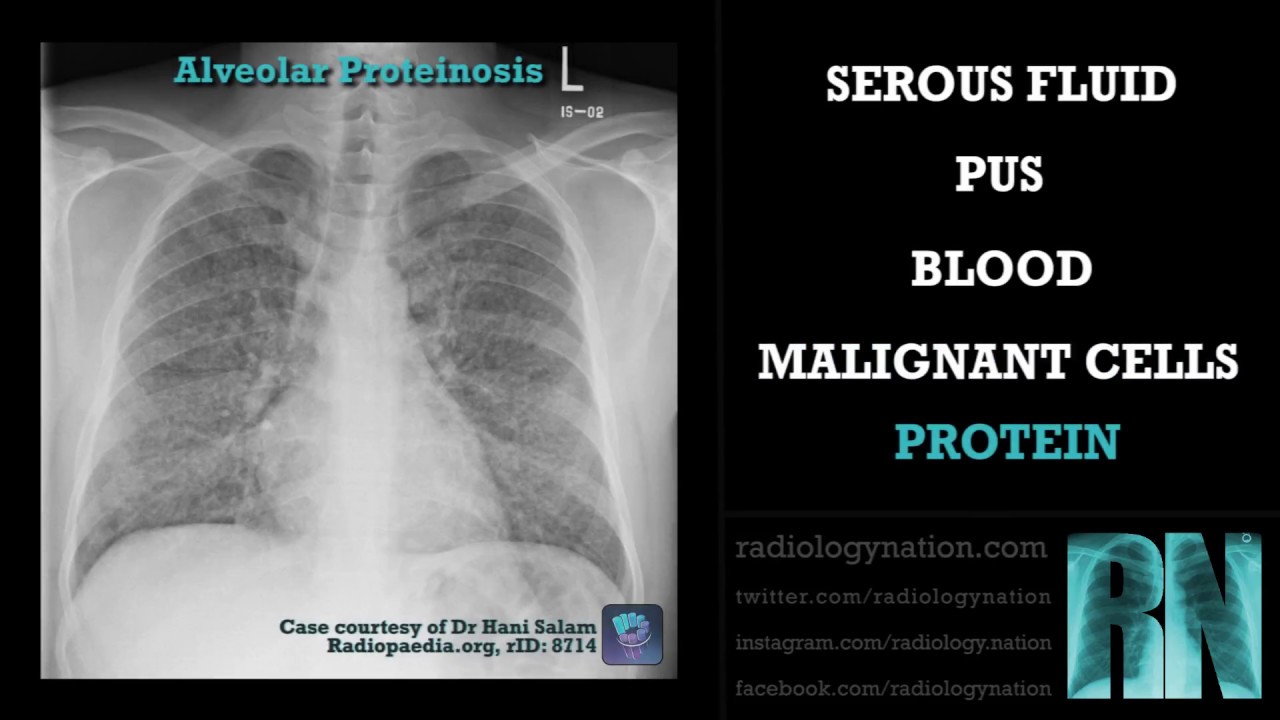 Chest X Ray Consolidation Vs Infiltrate