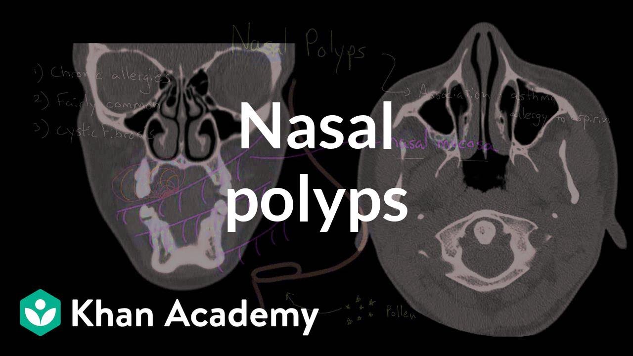 Nasal Polyps X Ray