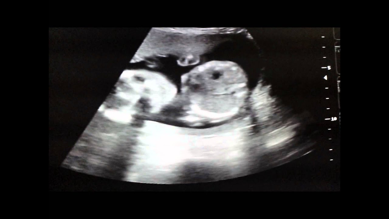 Ultrasound // Gender reveal! - YouTube