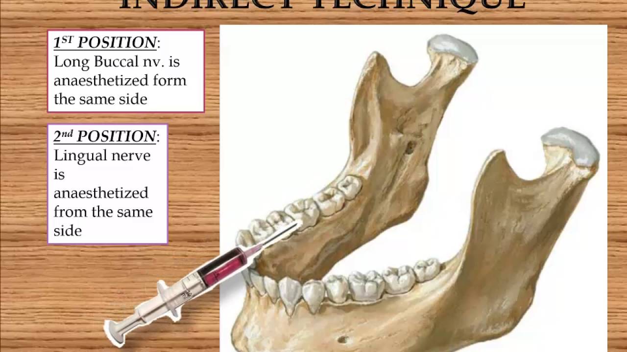 Inferior Alveolar Nerve Block Anatomical Landmarks