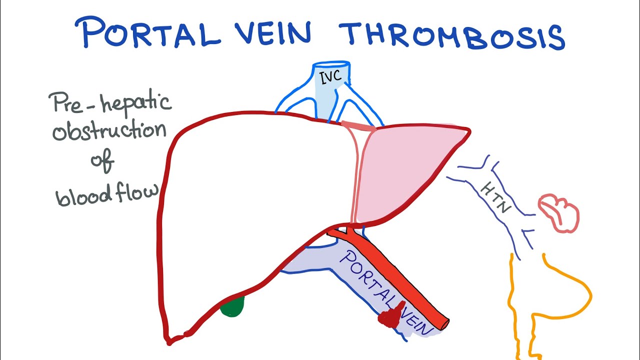 Recommended Algorithm For Treatment Of Acute Portal Vein Thrombosis