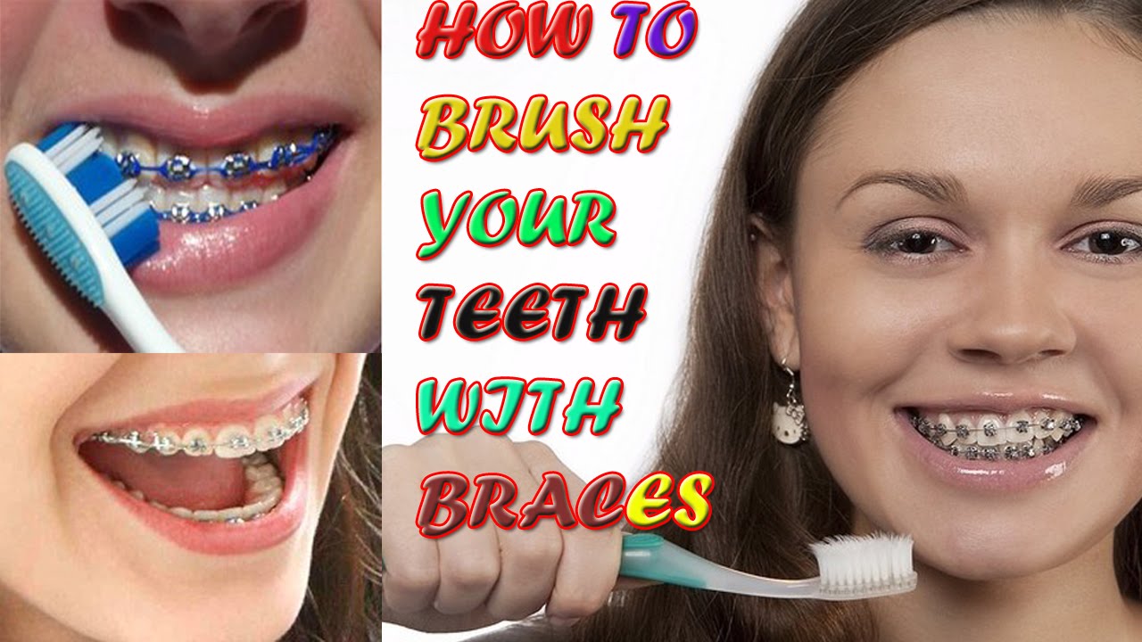 How To Correctly Brush Your Teeth With Braces - Reverasite